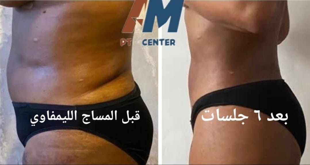 تصريف ليمفاوي — بعد 6 جلسات