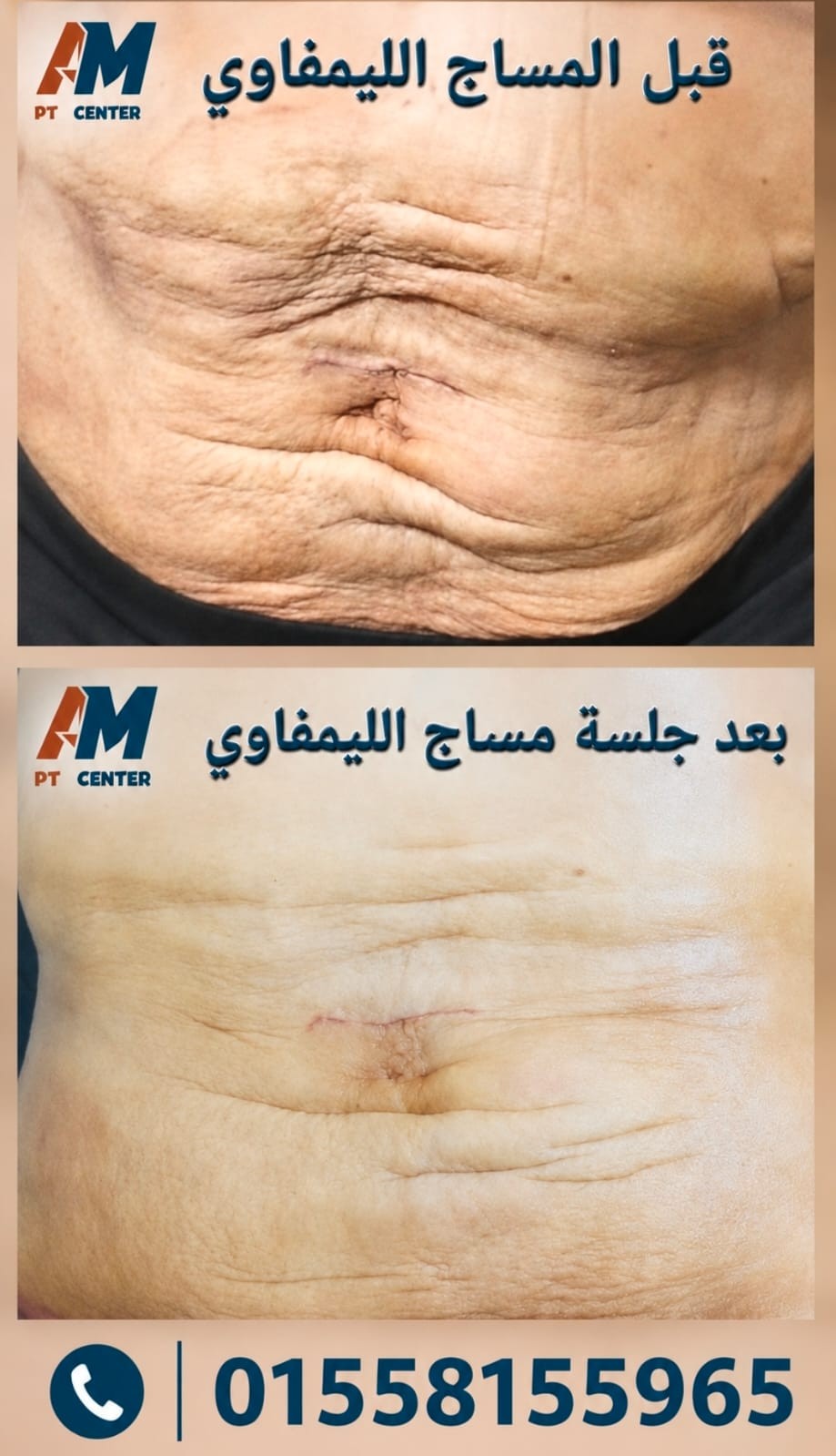 المساج الليمفاوي للبطن