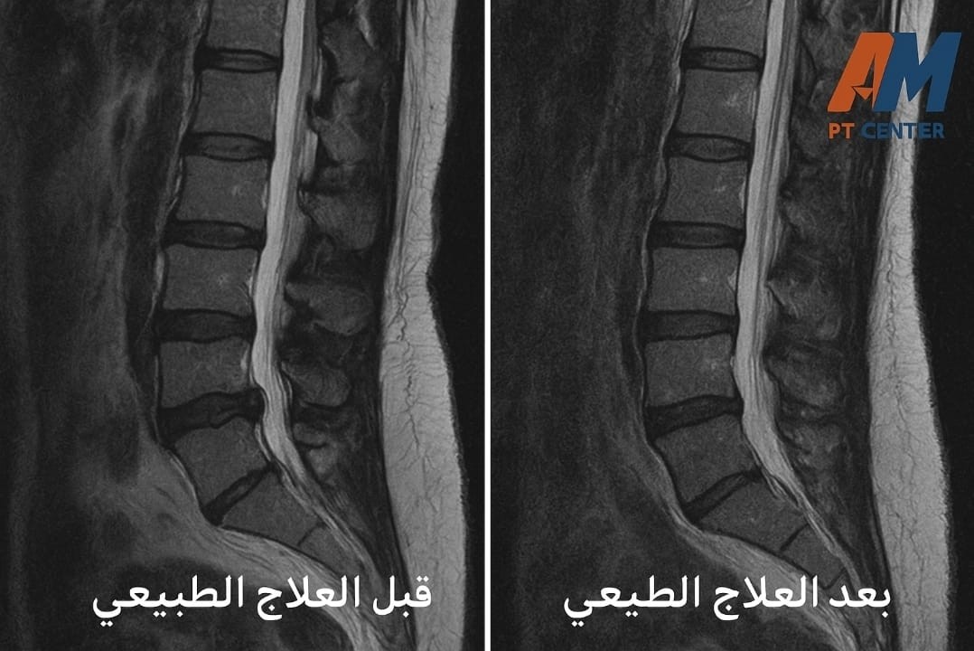 انزلاق غضروفي — قبل وبعد العلاج